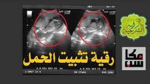 الرقيه الشرعيه للاطفال وللسحر والمس ولتثبيت الحمل باذن الله قويه جدا بصوت الشيخ ماهر المعيقلي