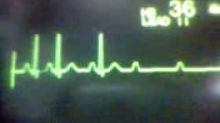 ECG Video: AV Block - Second Degree Type 2