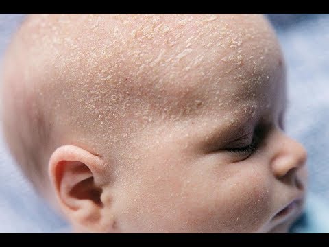 Video: A tund kokën foshnja me infeksion të veshit?