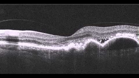 OCT Video Tutorial Wet AMD