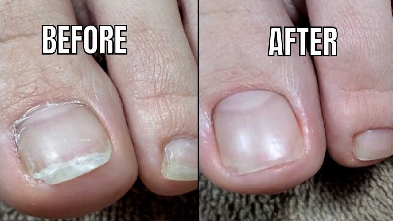 美甲教學2021 | 慎入！嵌甲處理大公開，清理過程超療癒 Pedicure/Ingrown Toenail