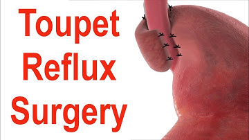 Toupet Fundoplication or 270° Stomach Wrap Surgery to Treat Reflux Animation