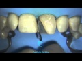 Direct Anterior Restorations