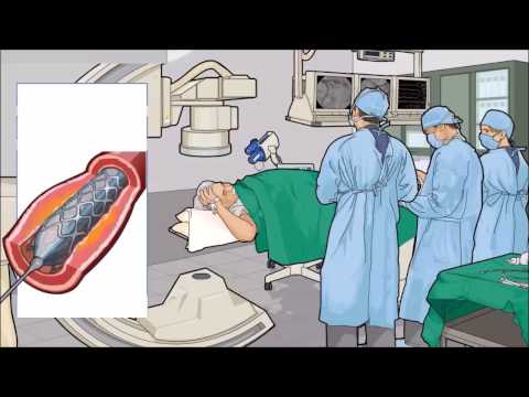 Video: Warum wird eine Koronarangiographie eingesetzt?