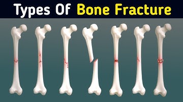 Common Types of bone Fractures 3d Animation|Wahab