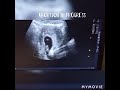 abortion in progress | ultrasound case