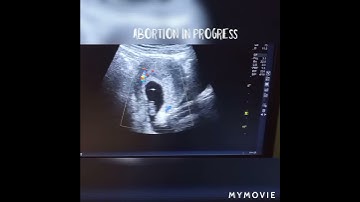abortion in progress | ultrasound case