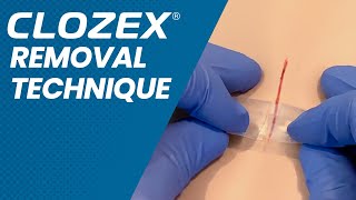 Clozex Removal Technique