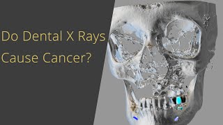 Do Dental X Rays Cause Cancer?