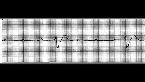 Complete Heart Block