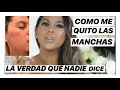 COMO QUITAR LAS MANCHAS DE LA CARA/MELASMA/ EL PAÑO/ LINREVE / HYPERPIGMENTATION/ JACKIE HERNANDEZ
