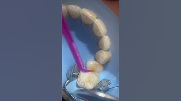 Cận cảnh quá trính trám răng sâu nhỏ #sâurăng #trámrăng #nhakhoa