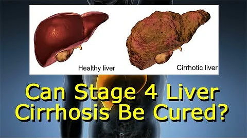 Can Stage 4 Liver Cirrhosis Be Cured? - DayDayNews