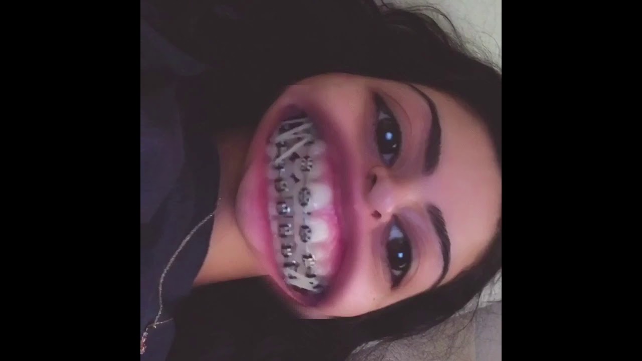 BRACES UPDATE Getting Rubber bands YouTube