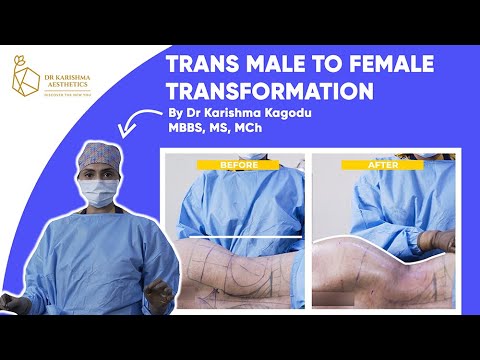 Trans Male to Female Transformation | Dr. Karishma Aesthetics| India