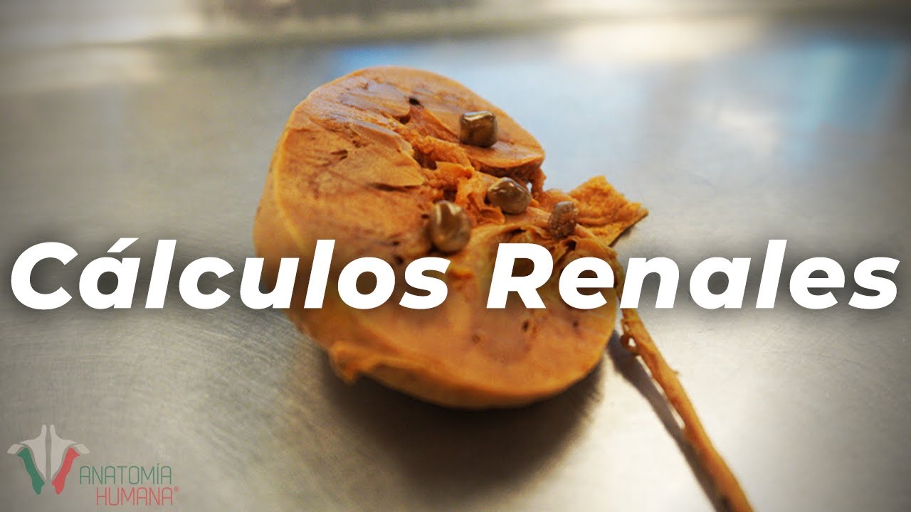 La cosa MAS DOLOROSA que TU PODRIAS EXPERIMENTAR?! | Cálculos Renales
