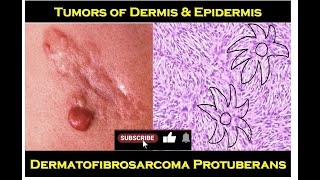 8n - Dermatofibrosarcoma Protuberans screenshot 5