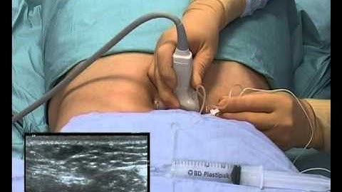 Rectus Sheath Block (ultrasound guided)