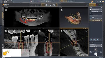 SICAT Implant 2.0 - Implant, Abutment & Sleeve Planning