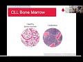 Chronic lymphocytic leukemia cll what it is when to treat and whats ahead