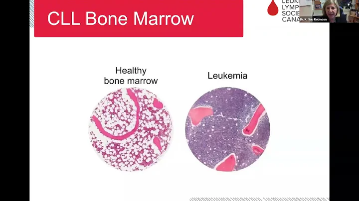 Chronic lymphocytic leukemia (CLL): What it is when to treat and what’s ahead