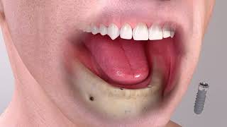 2 implant supported overdenture animation
