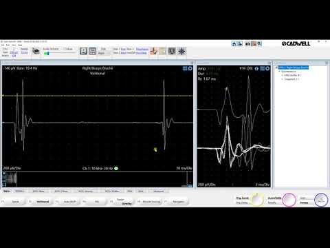 EMG+ Basic Functions  Cadwell Sierra Summit 3 1