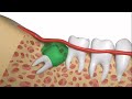 How to safely and quickly have a wisdom tooth extraction