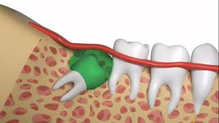 How To Safely and Quickly Have a Wisdom Tooth Extraction Resimi