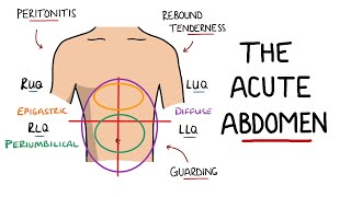 Acute Abdomen - A Guide to Acute Abdominal Pain