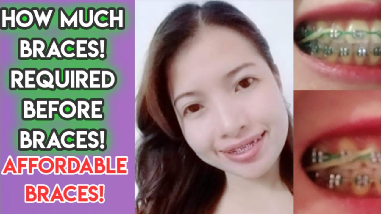 All About Braces How much braces REQUIREMENT YouTube