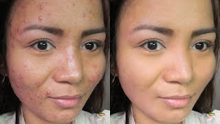 How to REMOVE ACNE in Photoshop!! screenshot 2
