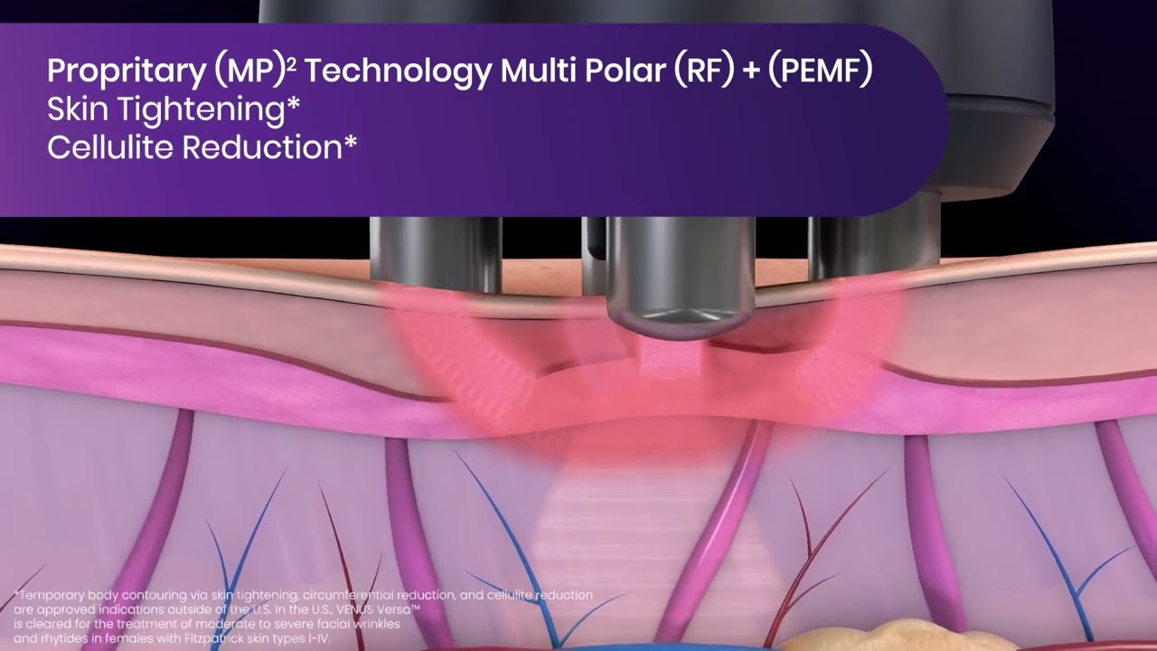 Multi Polar Technology - Versa Pro