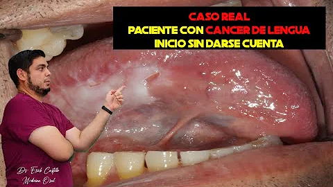 ¿Cuál es la lesión precancerosa oral más frecuente?