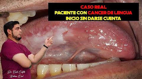 ¿Qué aspecto tiene una lengua cancerosa?