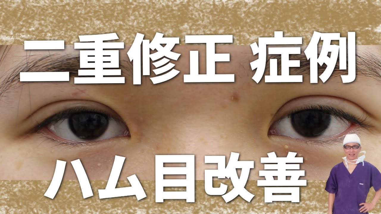 二重修正手術、ハム目改善の症例を執刀医が解説します