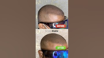 SMP in hair transplant density buildup #scalpmicropigmentation #smp #scalpdots