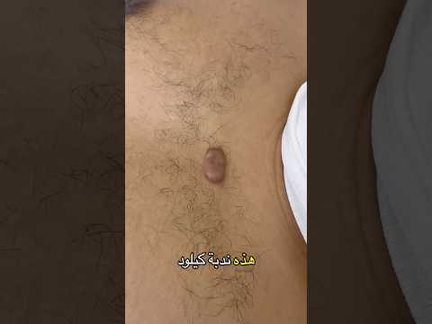ندبة الكيلويد  