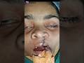 Secondary Lip Revision &amp; Alveolar Bone Grafting Surgery in Adult Cleft Patient.