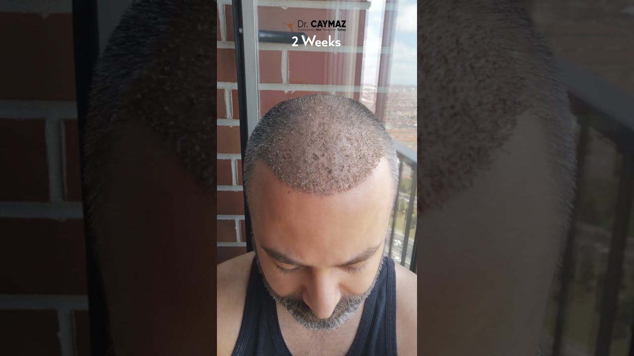 Hair Growth Progress