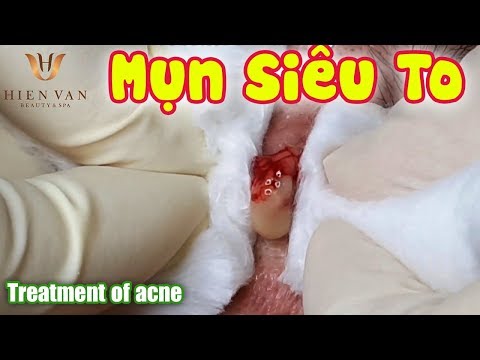 Cách điều trị mụn u nang hiệu quả | Acne Treatment |.Tại Hiền Vân Spa