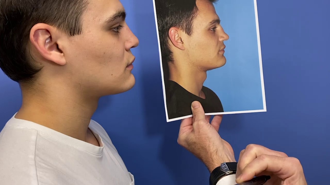 Why did I choose an Allograft for my Rhinoseptoplasty?