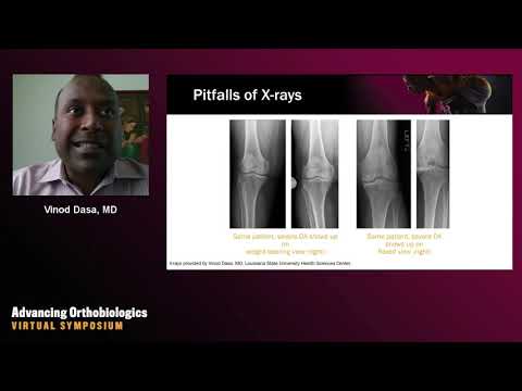 Video: Chondroprotektoriai Nuo Artrozės