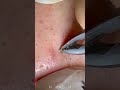 Skincare | Blackheads Removal #508 #tweezers skincare #blackheads blackheads