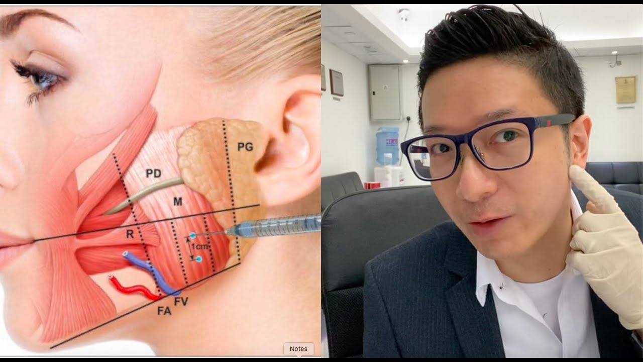 HK 6500鍾經略醫生親身示範Botox瘦面注射