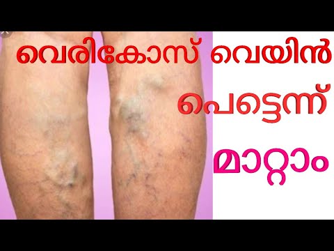 വെരിക്കോസ് വെയിൻ പൂർണമായും എളുപ്പത്തിൽ മാറ്റാം /natural home remedies for varikose veyin tips para cuidar el agua