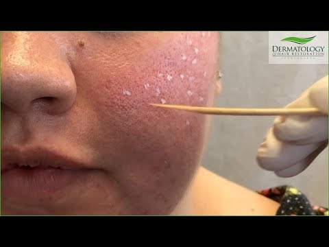 ACNE SCAR Treatment - TCA Cross - Los Angeles