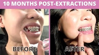 10 months after 4 pre-molars extraction | braces UPDATE!
