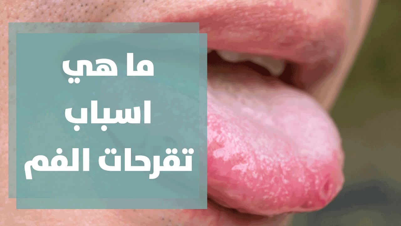 تعرف على أسباب تقرحات الفم المتكررة