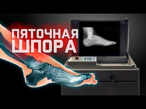 Видео: Выявится ли шип на рентгене?